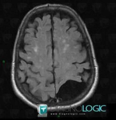 Arachnoid cyst, Supratentorial peri cerebral spaces, MRI