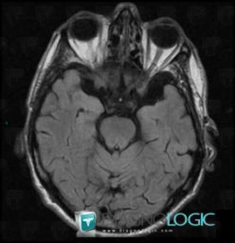 Arachnoid cyst, Supratentorial peri cerebral spaces, MRI