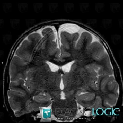 Arachnoid cyst, Supratentorial peri cerebral spaces, MRI