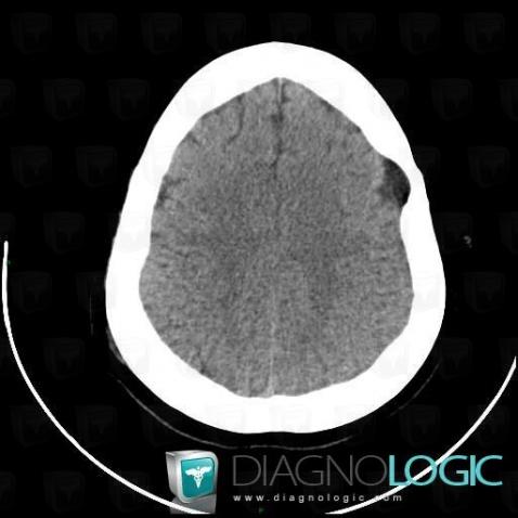 Arachnoid cyst, Supratentorial peri cerebral spaces, Skull vault, CT