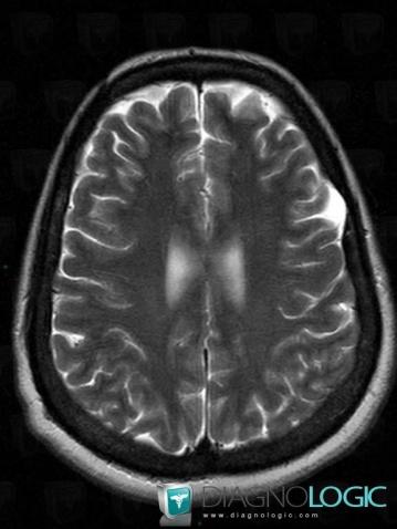 Arachnoid cyst, Supratentorial peri cerebral spaces, Skull vault, MRI