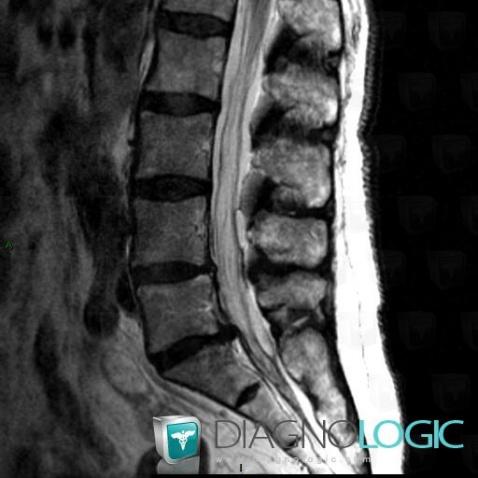 Arachnoiditis, Spinal canal / Cord, MRI