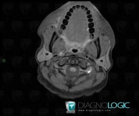 Arterial dissection, Arteries - Head and neck, MRI