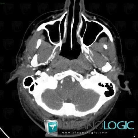 Arterial dissection, Internal carotid artery, CT