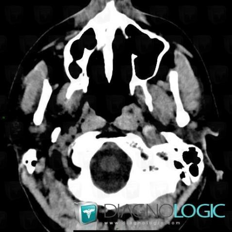 Arterial dissection, Internal carotid artery, CT