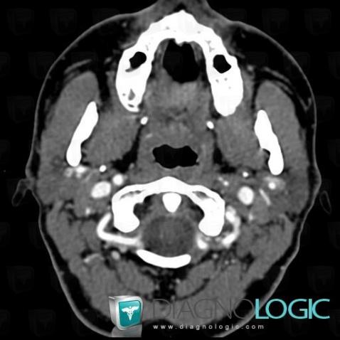 Arterial dissection, Internal carotid artery, CT