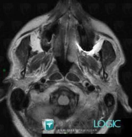 Arterial dissection, Internal carotid artery, MRI