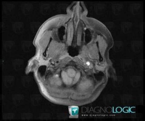 Arterial dissection, Internal carotid artery, MRI