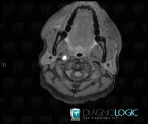 Arterial dissection, Internal carotid artery, MRI