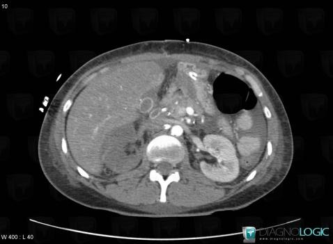 Arterial thrombosis, Abdominal aorta branches, CT