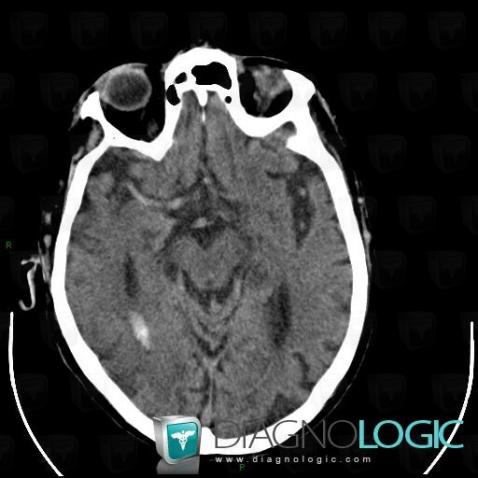 Arterial thrombosis, Cerebral arteries, CT