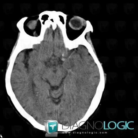 Arterial thrombosis, Cerebral arteries, CT