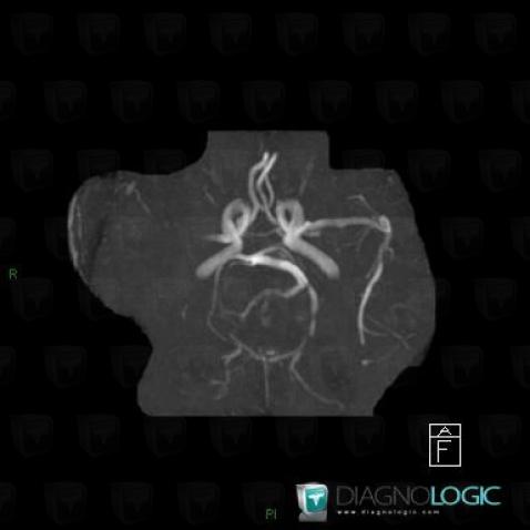 Arterial thrombosis, Cerebral arteries, MRI