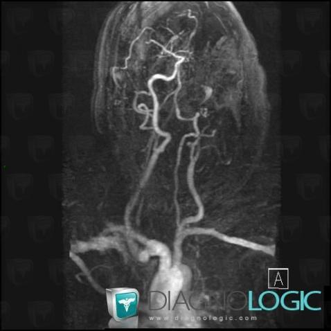 Arterial thrombosis, Internal carotid artery, MRI