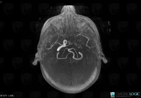 Arterial thrombosis, Internal carotid artery, MRI