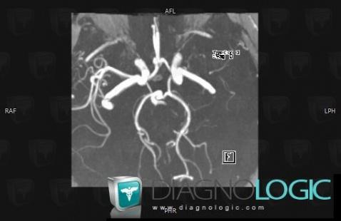 Arterial thrombosis, Internal carotid artery, MRI