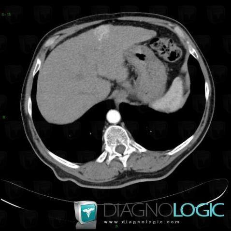 Arterioportal shunt, Liver, CT