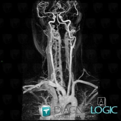 Arteriovenous fistula, Arteries - Head and neck, MRI