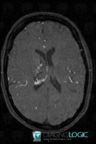 Arteriovenous malformation, Basal ganglia and capsule, MRI