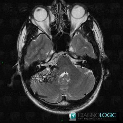 Arteriovenous malformation, Cerebellar hemisphere, Cerebellopontine angle, MRI