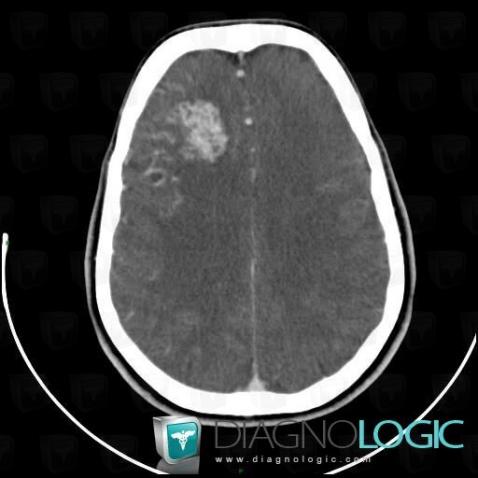 Arteriovenous malformation, Cerebral hemispheres, CT