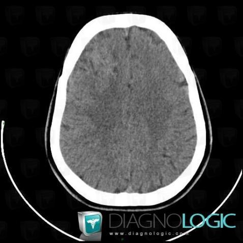 Arteriovenous malformation, Cerebral hemispheres, CT