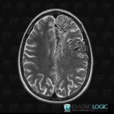 Arteriovenous malformation, Cerebral hemispheres, MRI