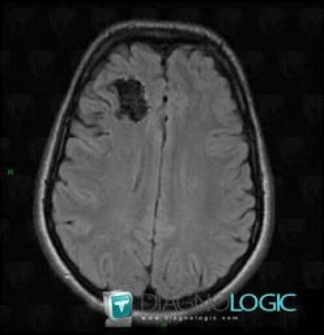 Arteriovenous malformation, Cerebral hemispheres, MRI