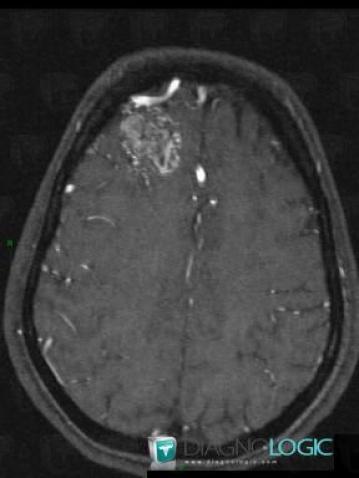 Arteriovenous malformation, Cerebral hemispheres, MRI