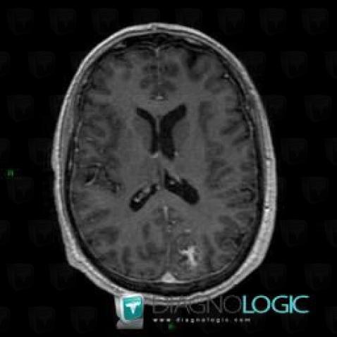 Arteriovenous malformation, Cerebral hemispheres, MRI