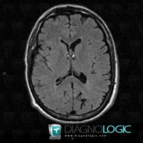 Arteriovenous malformation, Cerebral hemispheres, MRI