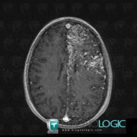 Arteriovenous malformation, Cortico subcortical region, Cerebral hemispheres, MRI