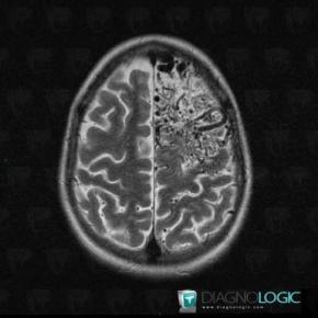 Arteriovenous malformation, Cortico subcortical region, MRI