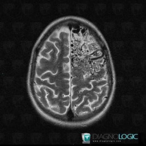 Arteriovenous malformation, Cortico subcortical region, MRI