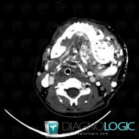 Arteriovenous malformation, Deep facial spaces, CT