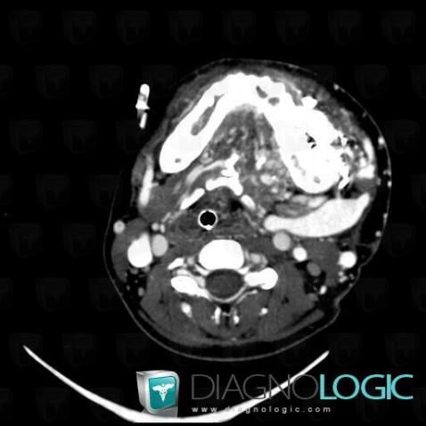 Arteriovenous malformation, Deep facial spaces, CT