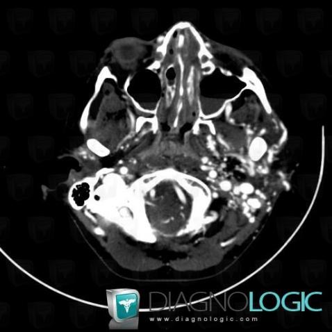 Arteriovenous malformation, Deep facial spaces, CT