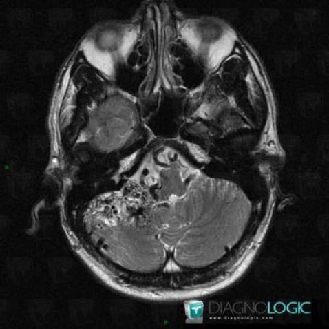 Arteriovenous malformation, Posterior fossa, MRI