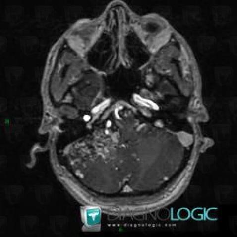 Arteriovenous malformation, Posterior fossa, MRI