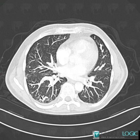 Arteriovenous malformation, Pulmonary parenchyma, CT