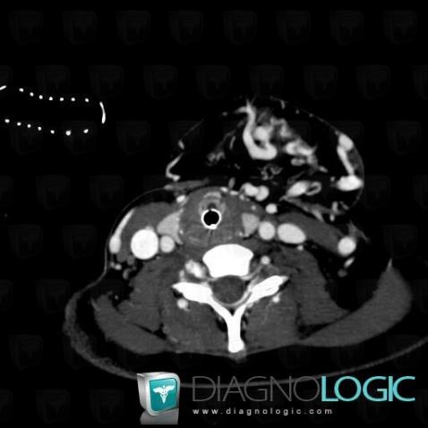 Arteriovenous malformation, Soft tissues - Head and neck, CT