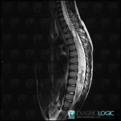 Arteriovenous malformation, Spinal canal / Cord, MRI