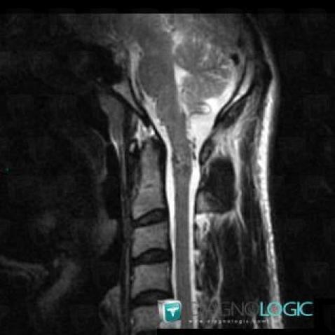 Arteriovenous malformation, Spinal canal / Cord, MRI