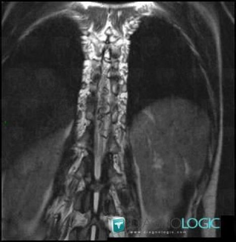 Radiology case : Arteriovenous malformation (MRI) - Diagnologic