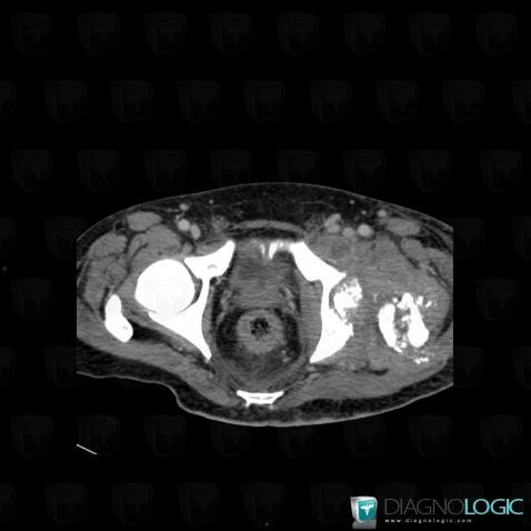 Arthrite septique, Articulation coxo fémorale, Scanner