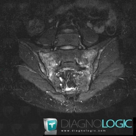 Arthrite septique, Articulation sacro iliaque, IRM