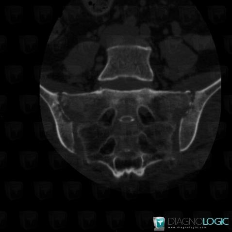 Arthrite septique, Articulation sacro iliaque, Scanner