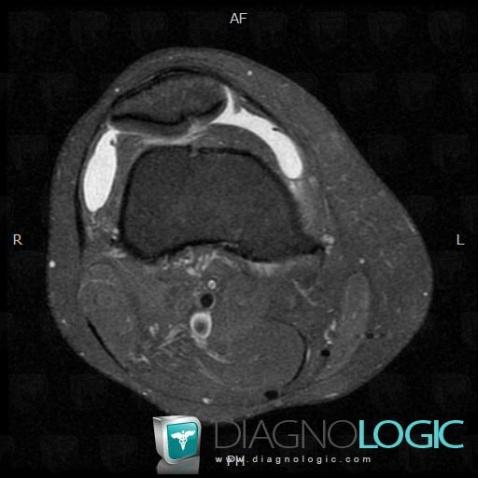 Arthrose, Articulation fémoro patellaire, IRM
