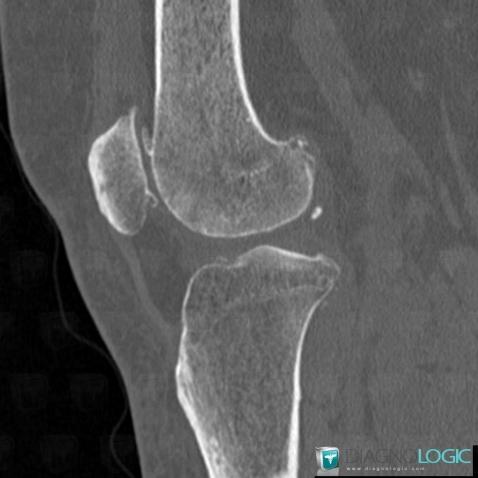 Arthrose, Articulation fémoro patellaire, Scanner