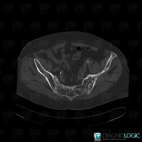 Arthrose, Articulation sacro iliaque, Scanner